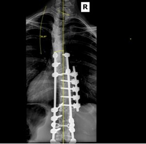 An X-Ray of Kait's spine and its curve.